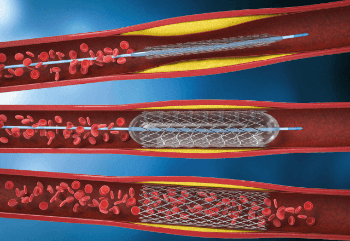 angioplastia-procedimento